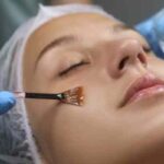 Chemical peel treatment