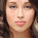 acne scar treatment in hyderabad